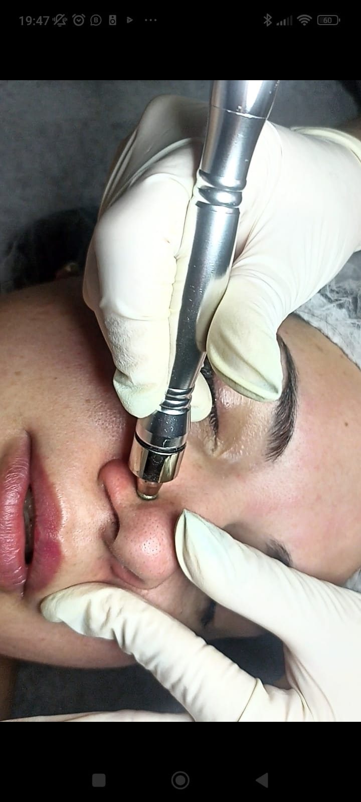 Microdermoabrasion con punta diamante