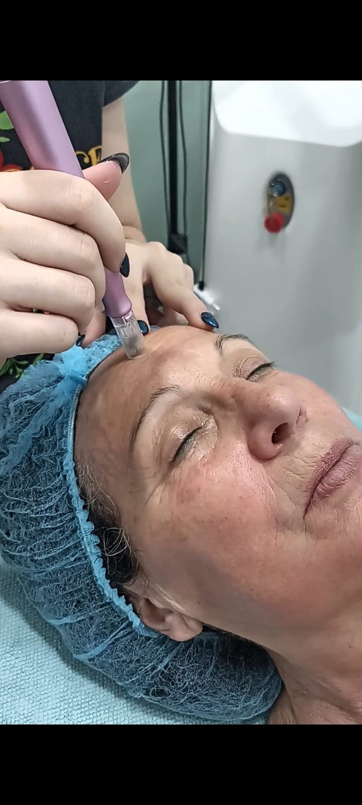 Microneedling