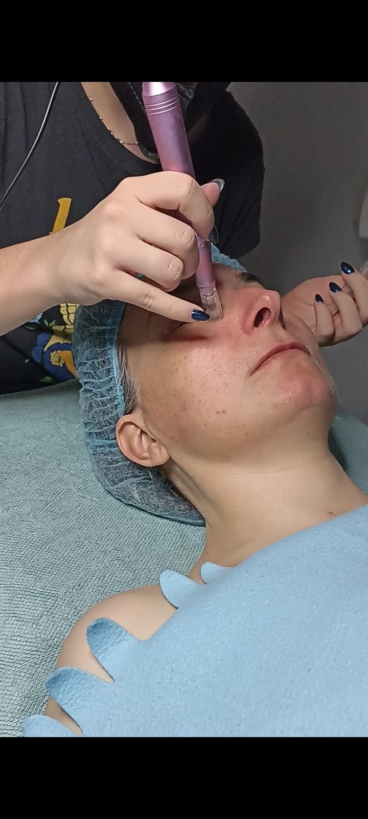 Microneedling