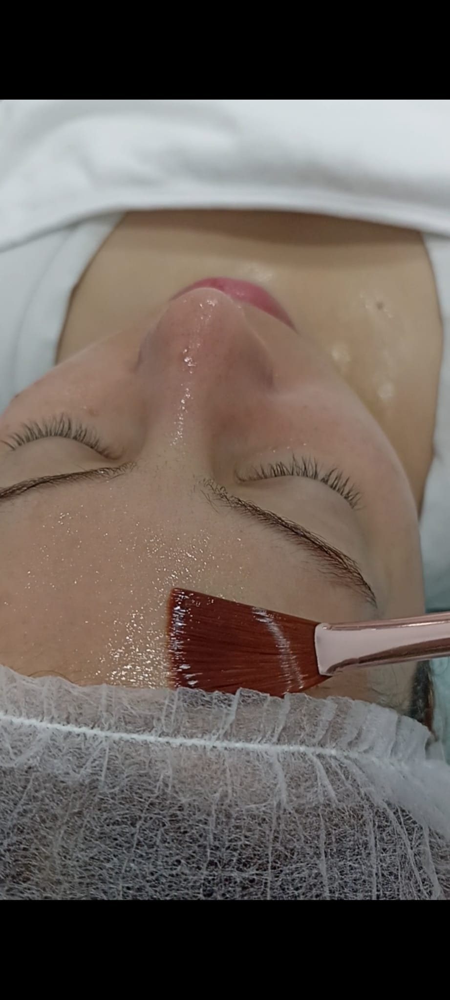 PEELING QUIMICO